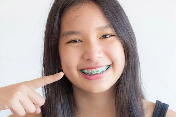 Người bị móm có nên niềng răng bằng cách mắc cài kim loại?