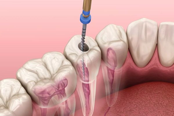 Tại sao cần phải điều trị tủy răng?