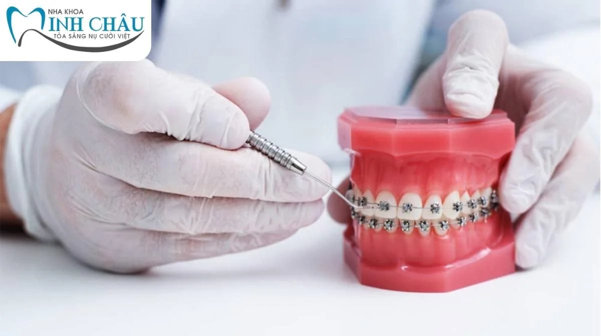 Răng bị hô hàm có niềng răng được không? 