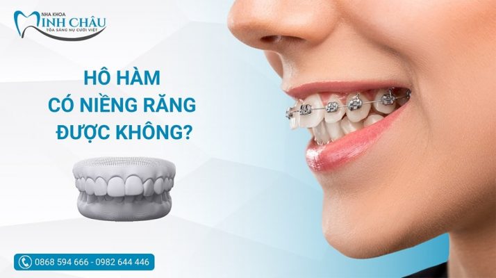 Răng bị hô hàm có niềng răng được không?