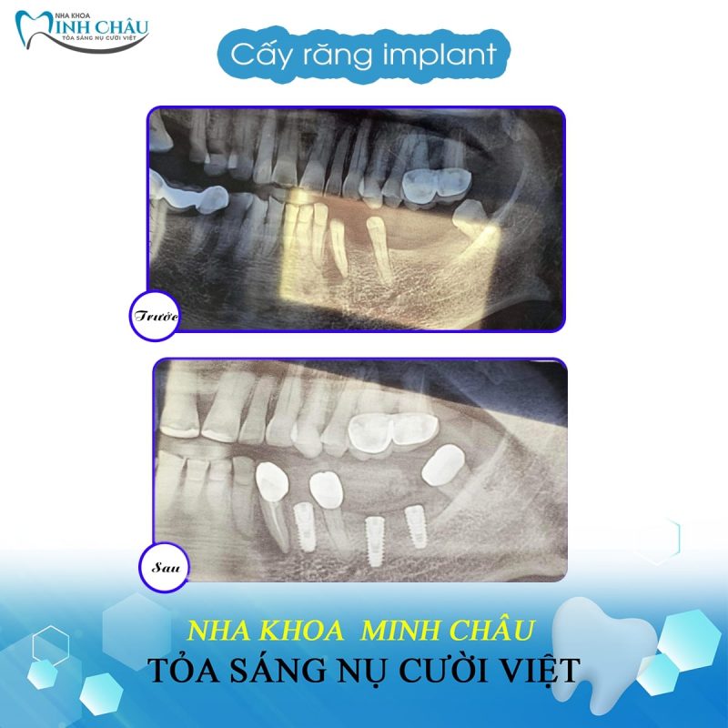 implant-3