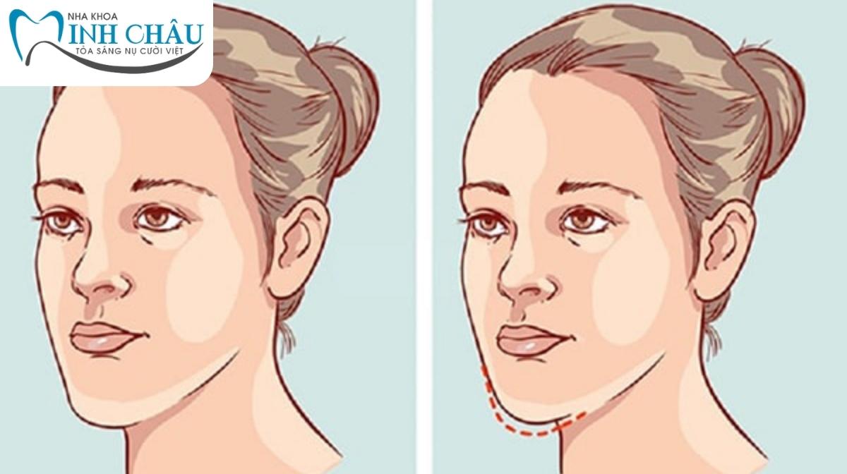 Răng ảnh hưởng đến khuôn mặt như thế nào?