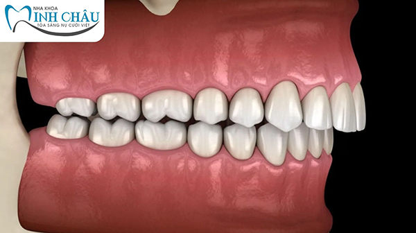 Răng hô hàm trên là gì?