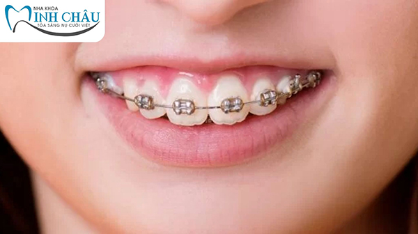 Niềng răng hô hàm trên có hiệu quả không?
