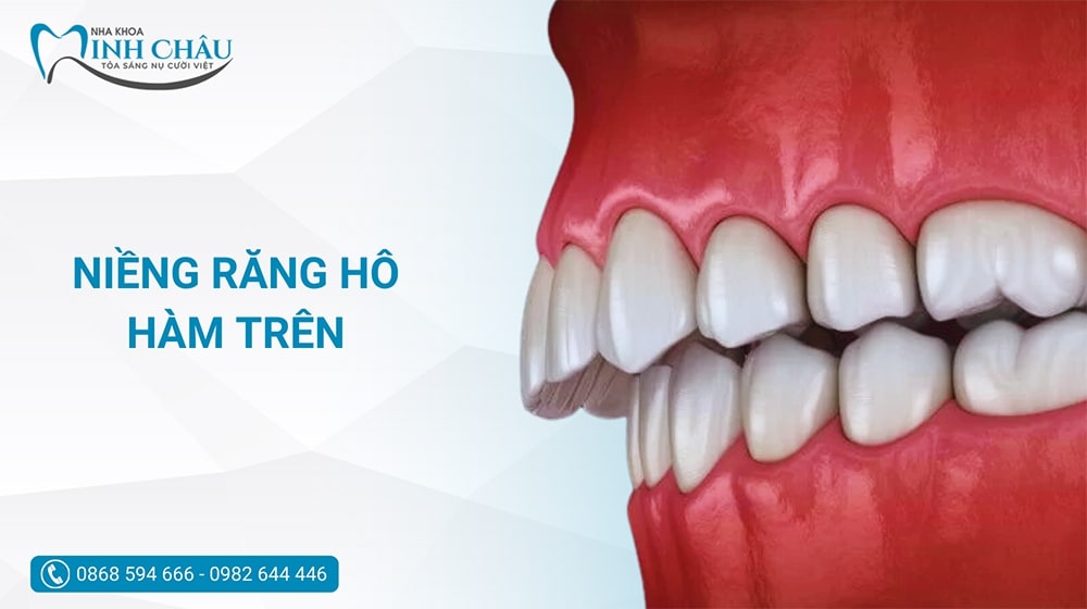 Liệu phương pháp niềng răng hô hàm trên có thực sự hiệu quả?