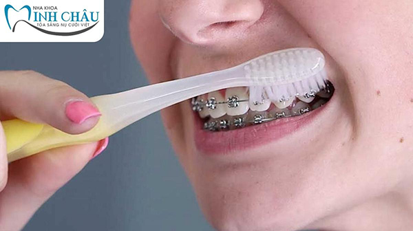 Vì sao nên chăm sóc răng niềng đúng cách?