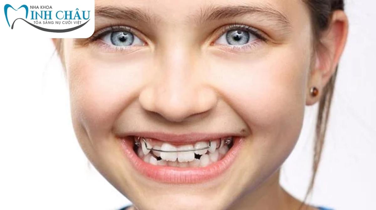 Niềng răng cho trẻ 8 tuổi có phù hợp?