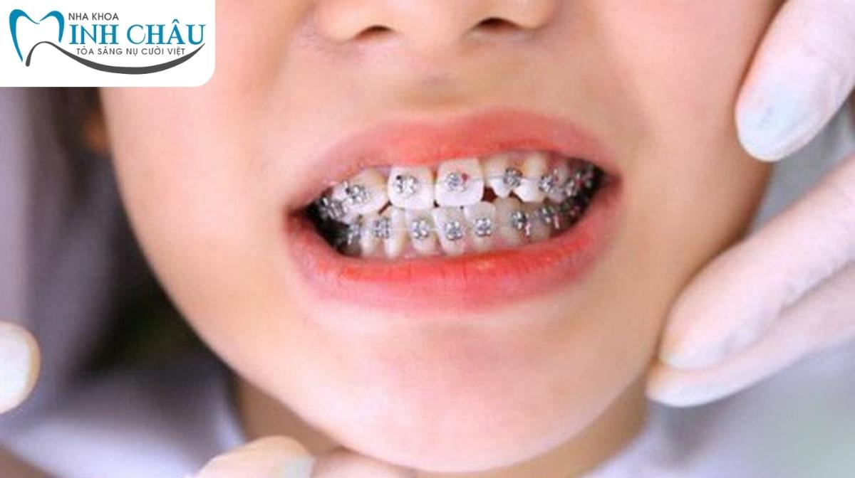 Cách để niềng răng cho trẻ đạt được hiệu quả cao nhất?