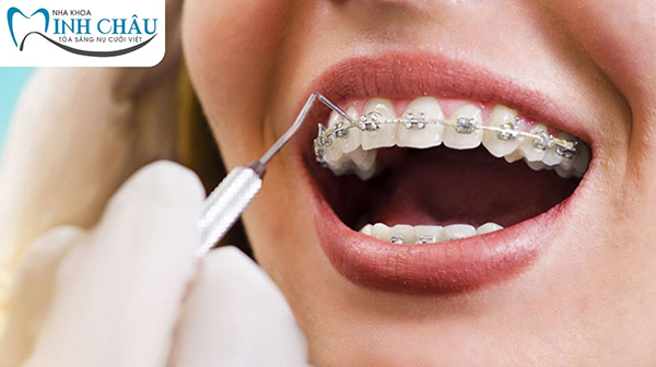 Thời gian thực hiện trung bình của các loại mắc cài niềng răng là bao lâu?