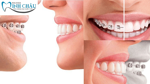 Răng thưa nên niềng răng hay bọc sứ?