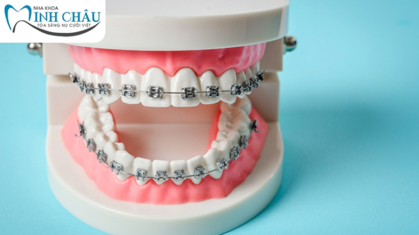 Khi niềng răng mắc cài kim loại thì giai đoạn nào gây đau nhức nhất?