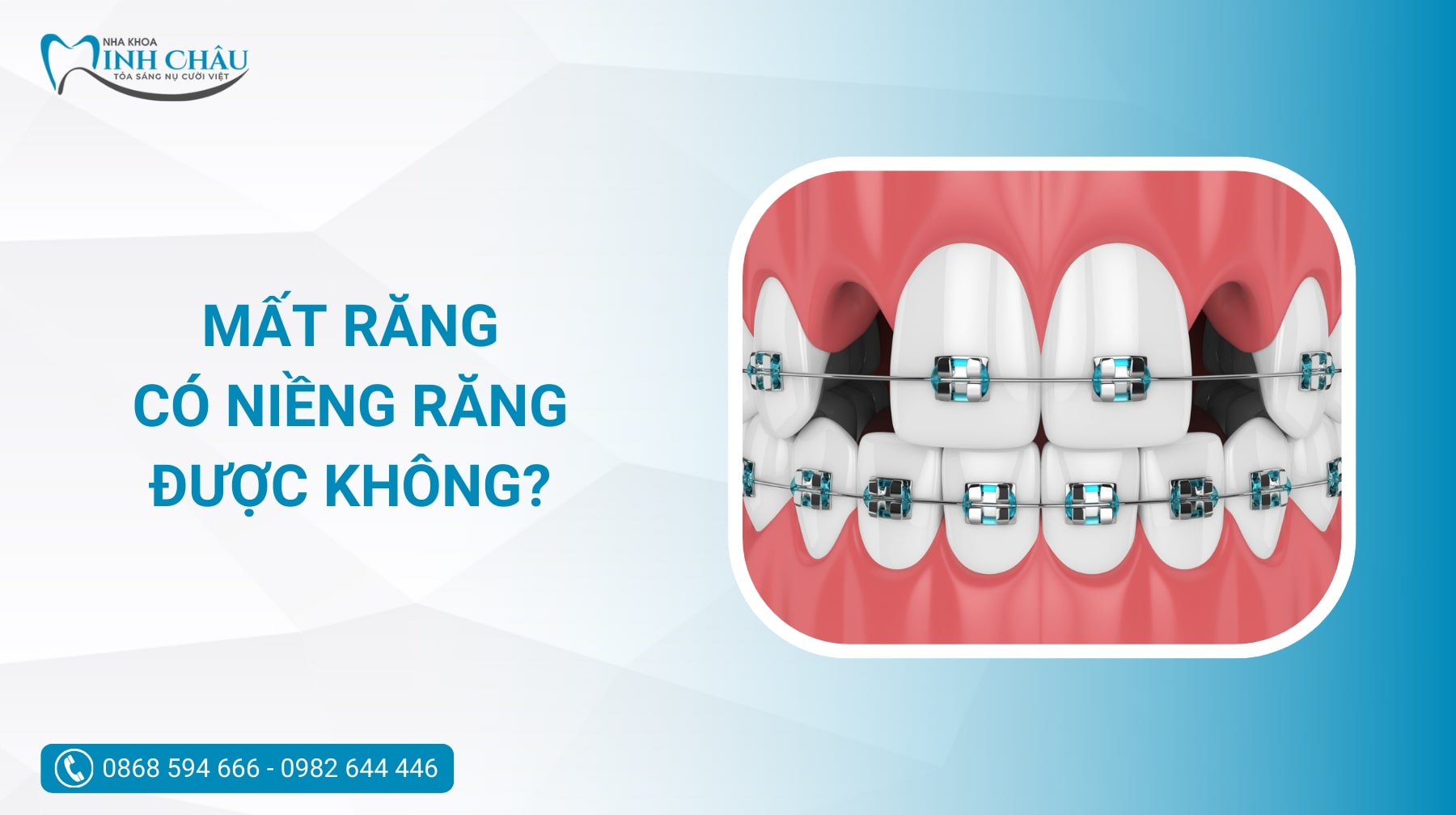 Mất răng có niềng răng được không? Giải pháp tối ưu nhất khi bị mất ...