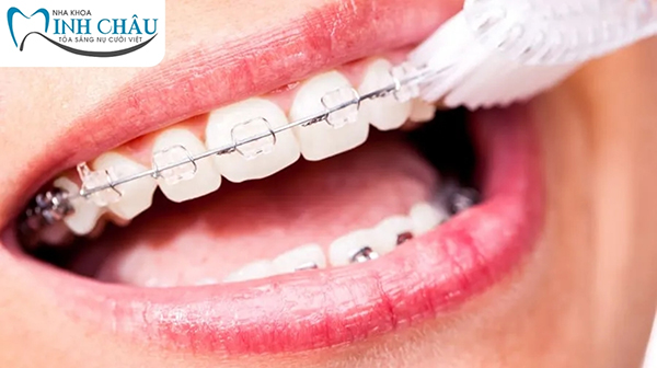 Cách chăm sóc răng miệng sau khi niềng răng mắc cài sứ