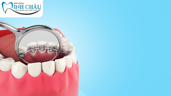 Niềng răng mặt lưỡi có khó chịu hơn các loại niềng răng khác không?