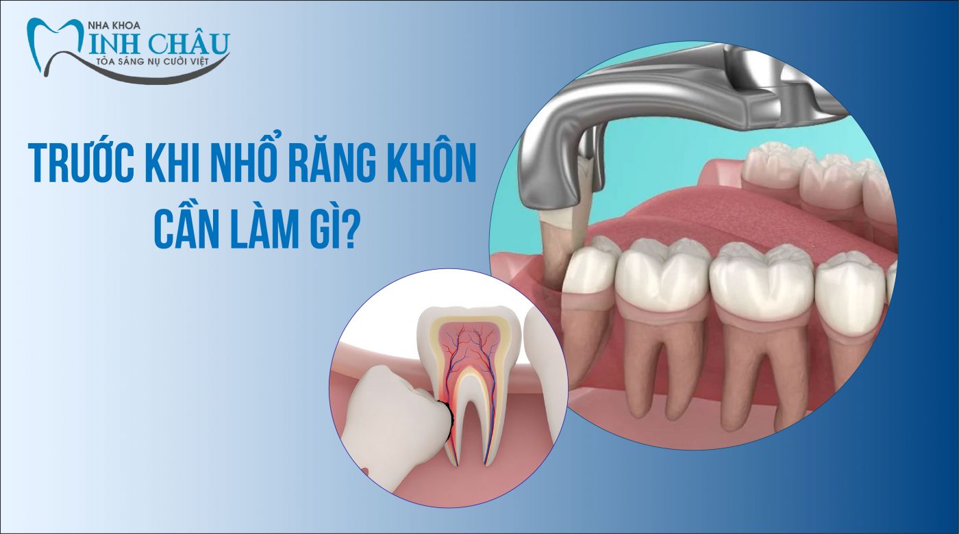 trước khi nhổ răng khôn cần phải làm gì