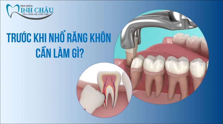 trước khi nhổ răng khôn cần phải làm gì