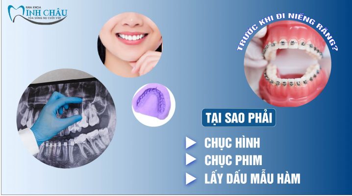 Lợi Ích Của Việc Chụp Hình, Chụp Phim, Lấy Dấu Mẫu Hàm Trước Khi Niềng Răng