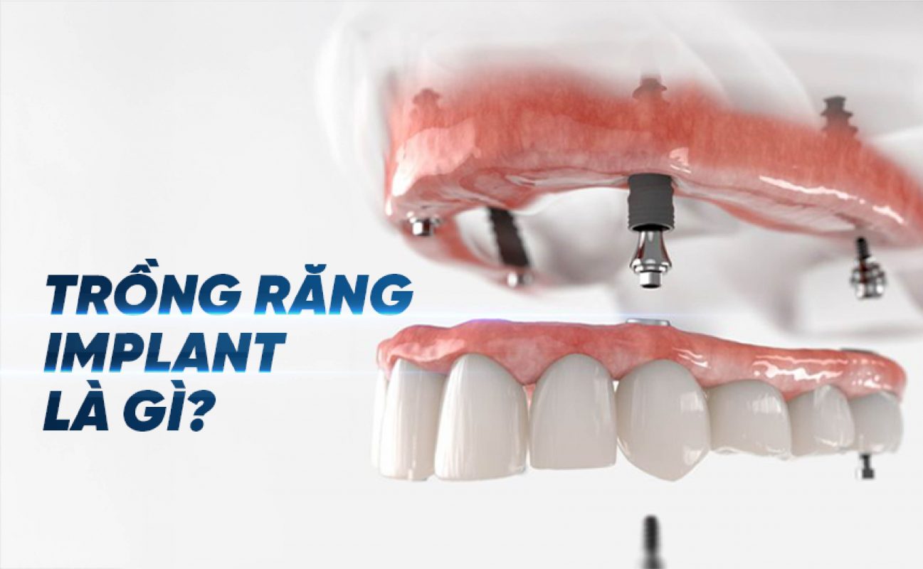 Trồng răng implant là gì?