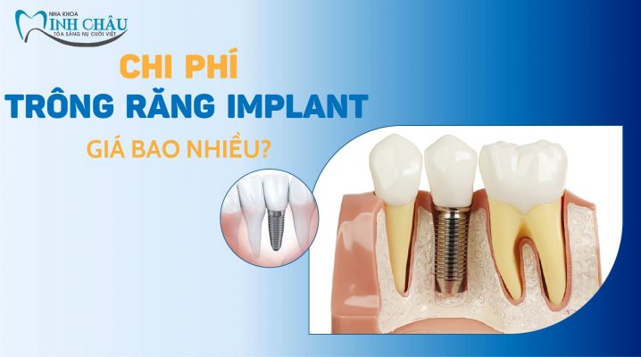 Chi phí trồng răng implant giá bao nhiêu