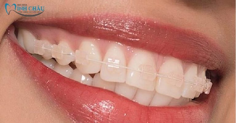niềng răng mắc cài sứ