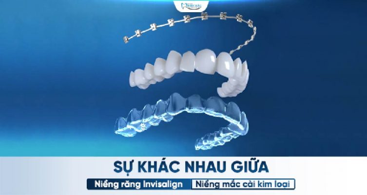 Niềng Răng Invisalign và Niềng Răng Mắc Cài