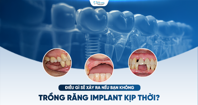 TRỒNG RĂNG IMPLANT