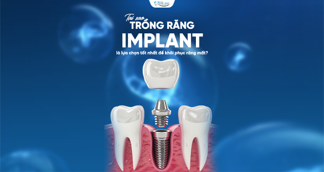 Trồng Răng Implant