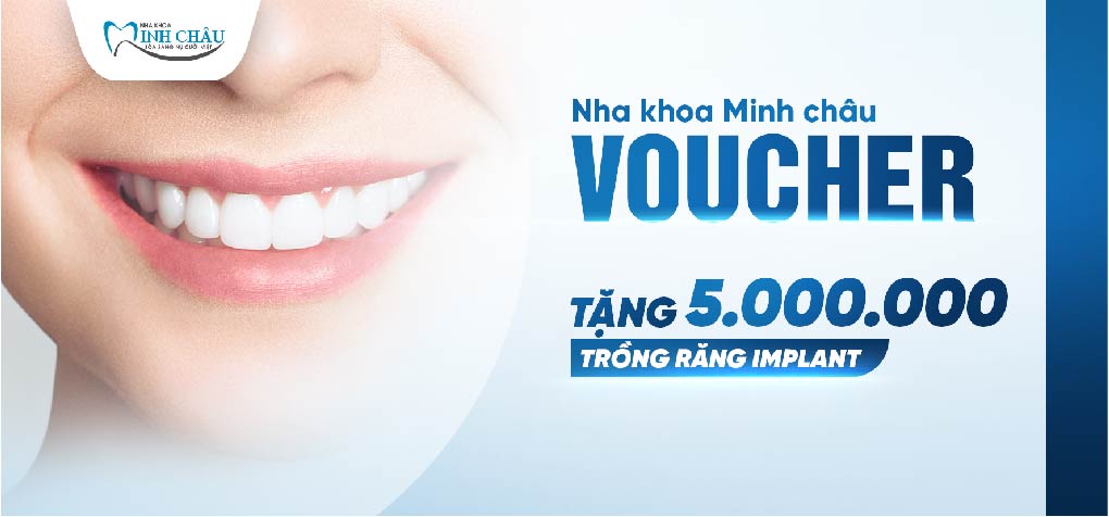 Nhận ngay voucher TẶNG 5.000.000 VNĐ cho mỗi răng implant