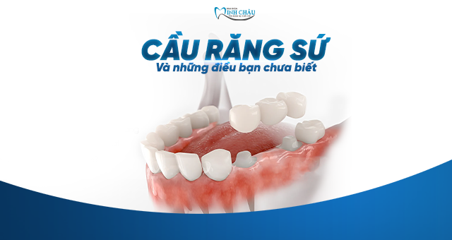 CẦU RĂNG SỨ VÀ NHỮNG ĐIỀU CHƯA BIẾT