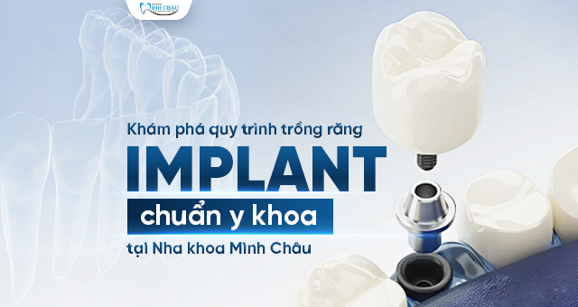 QUY TRÌNH TRỒNG RĂNG IMPLANT