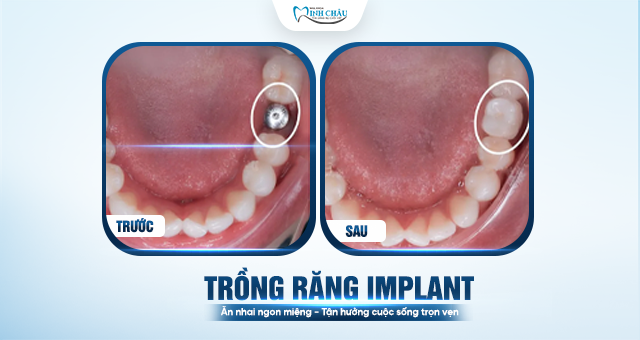 MẤT RĂNG NÀO, TRỒNG RĂNG ĐÓ