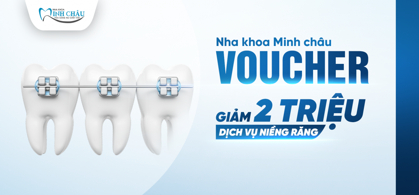 Giảm ngay 2 TRIỆU ĐỒNG cho dịch vụ niềng răng