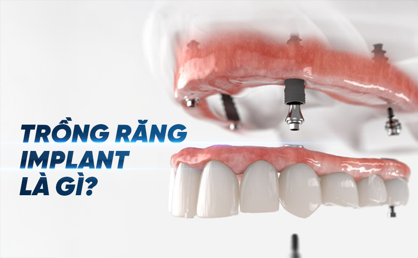 Trồng Răng Implant