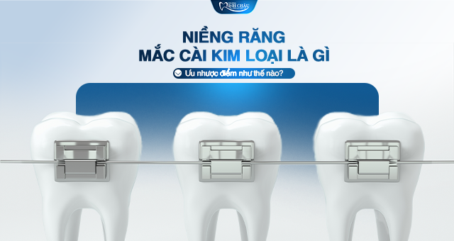 NIỀNG RĂNG MẮC CÀI KIM LOẠI