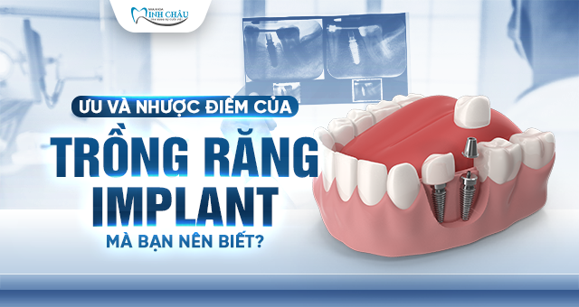 trồng răng implant