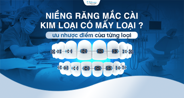 Niềng răng mắc cài kim loại có mấy loại - ưu nhược điểm của từng loại