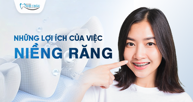 những lợi ích của việc niềng răng là gì