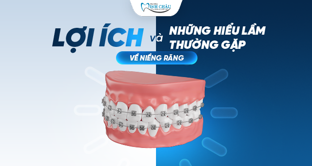 Lợi ích và những hiểu lầm thường gặp về niềng răng