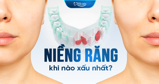 niềng răng khi nào xấu nhất