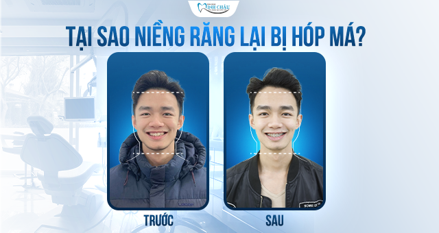 Tại sao niềng răng lại bị hóp má