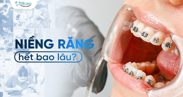 niềng răng hết bao lâu