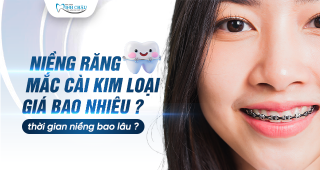 niềng răng mắc cài kim loại giá bao nhiêu - thời gian niềng bao lâu