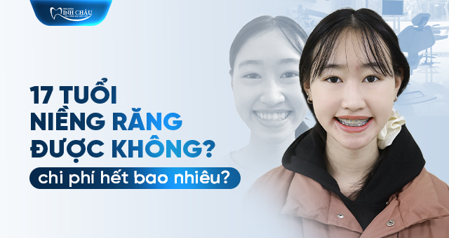 17 tuổi niềng răng được không? Chi phí & hiệu quả thế nào?
