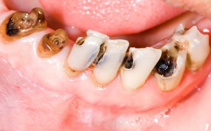 “trước và sau” răng bị hư sâu, ê buốt, đổi màu