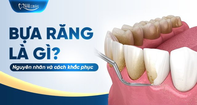 Bựa răng là gì? Nguyên nhân, cách khắc phục