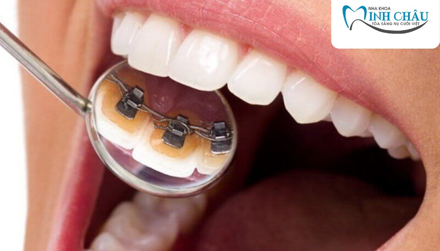Mắc cài kim loại mặt trong
