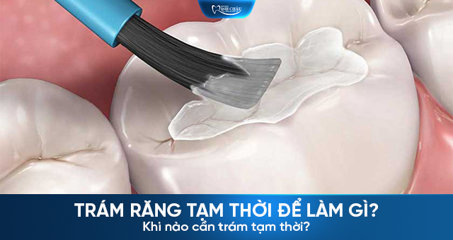 Trám răng tạm thời là gì? Khi nào cần trám răng tạm thời tại Nha khoa Minh Châu