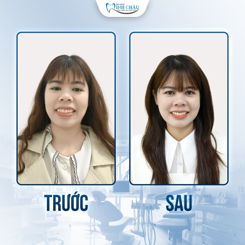 niềng răng mắc cài