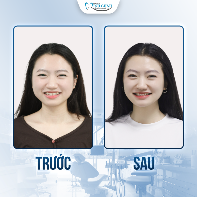 niềng trong suốt