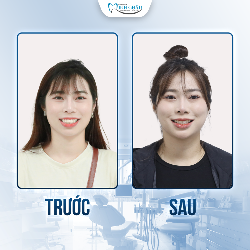 niềng trong suốt